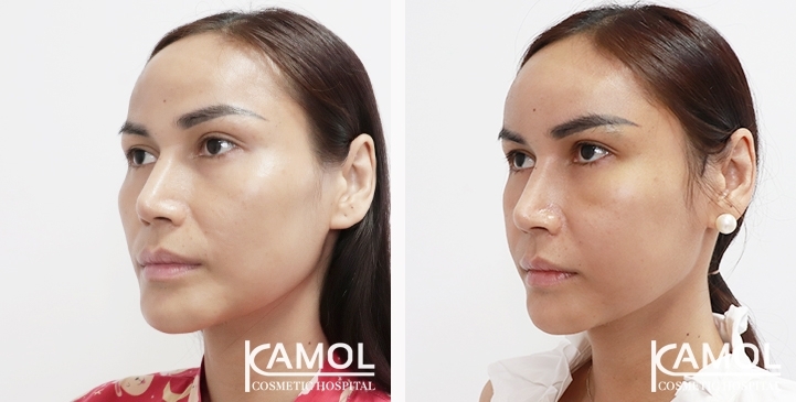 Before and After Cheekbone Augmentation