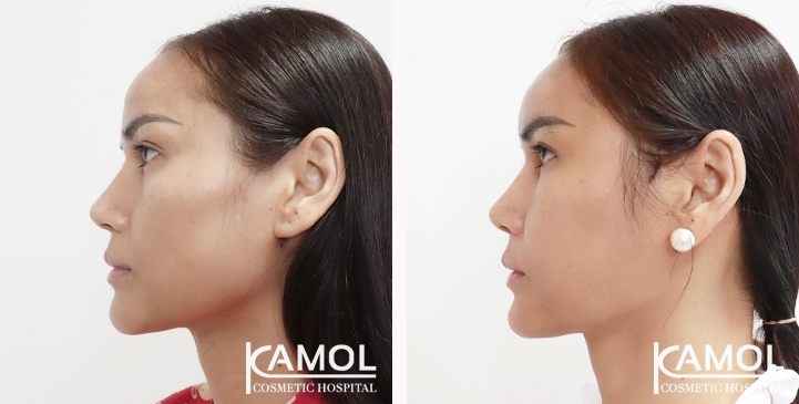 Before and After Cheekbone Augmentation