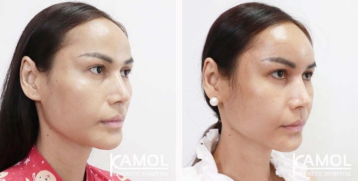 Before and After Cheekbone Augmentation