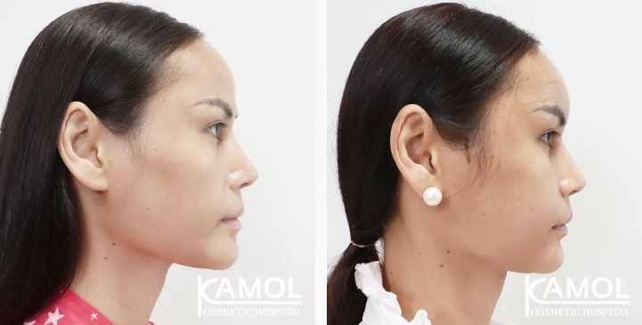 Before and After Cheekbone Augmentation