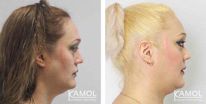 Before and After Cheekbone Augmentation