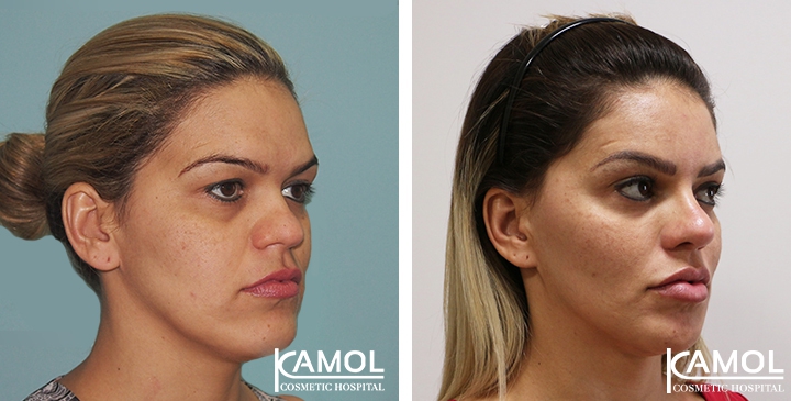 Before and After Cheekbone Augmentation