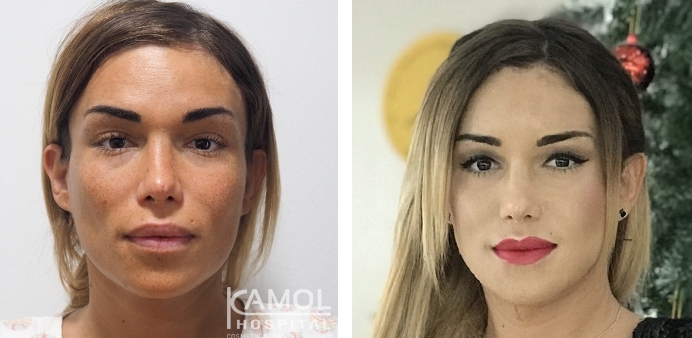 Before and After Cheekbone Augmentation