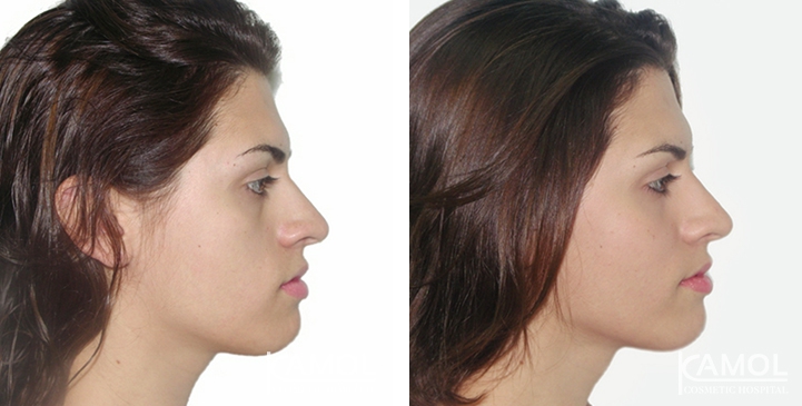 Before and After Cheekbone Augmentation