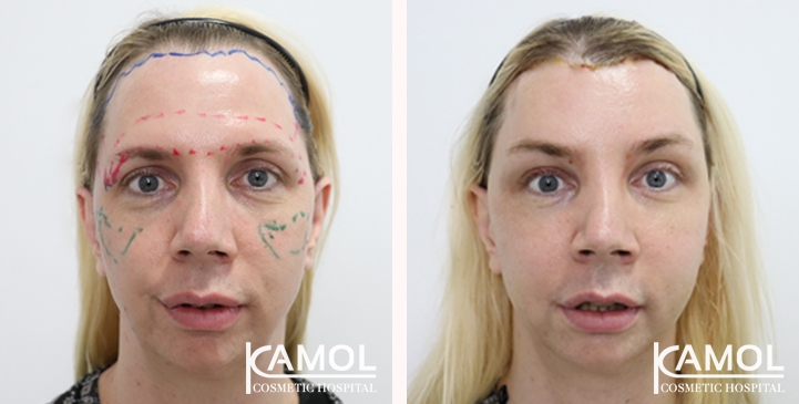 Cheek Augmentation,Hairline lowering,Forehead Lift,Forehead compression,Eye Brow Lift