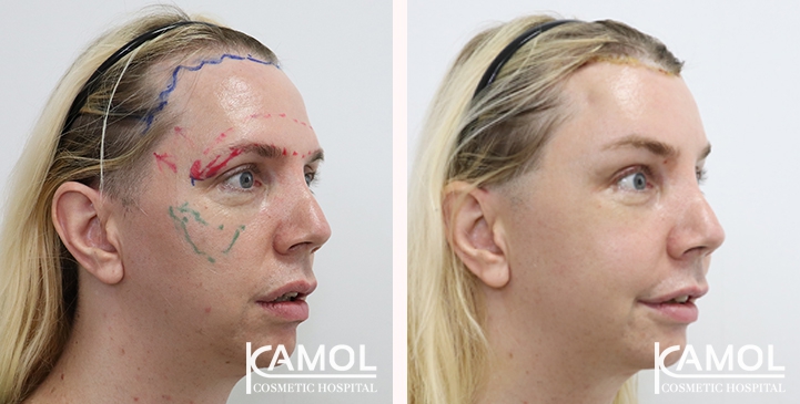 Cheek Augmentation,Hairline lowering,Forehead Lift,Forehead compression,Eye Brow Lift