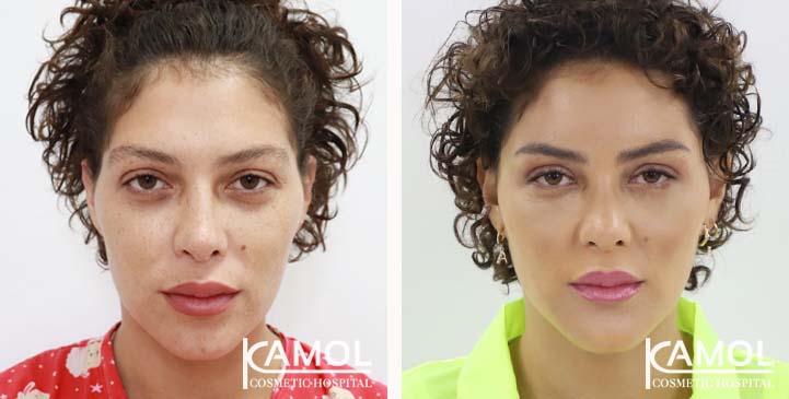 Facial Feminization Surgery