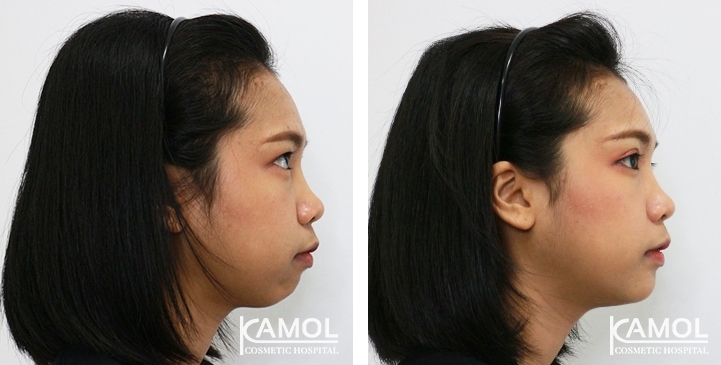 Before and After Chin Augmentation, Chin Implant