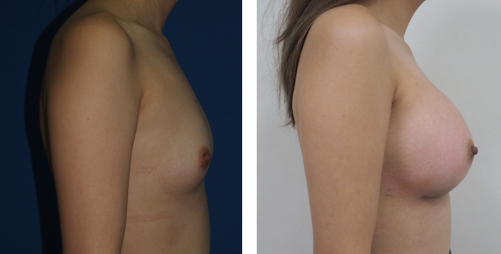 Male to Female Breast Surgery