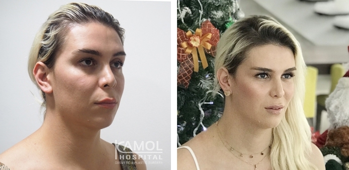 Before and After Side chin reduction and Chin Augmentation, Chin Implant