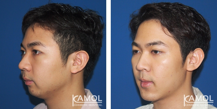 Before and After Genitoplasty, Chin Forward Sliding