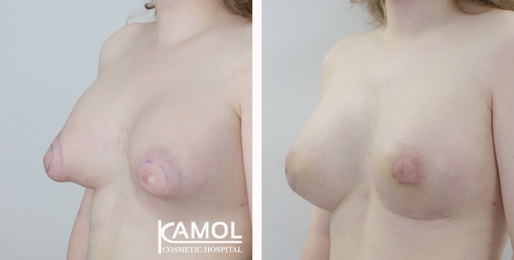 Male to Female Breast Surgery