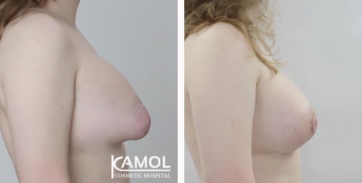 Male to Female Breast Surgery