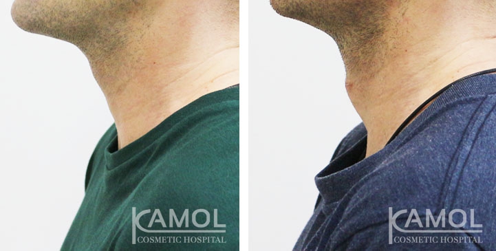 Adam’s apple Augmentation Surgery, Left side view