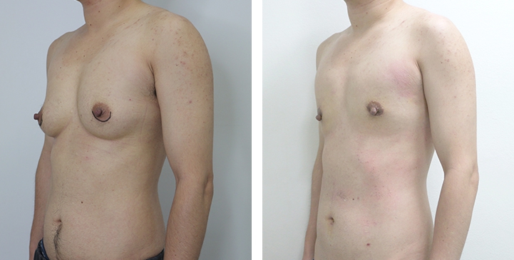 Before and After Mastectomy (Top Surgery)  U-Shape Scar technique