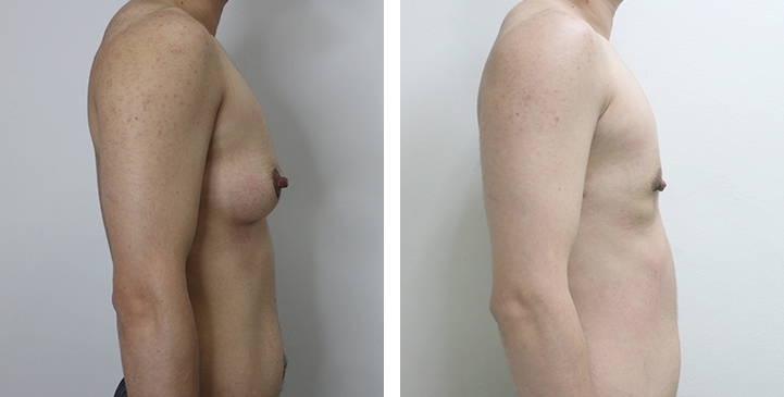 Before and After Mastectomy (Top Surgery)  U-Shape Scar technique