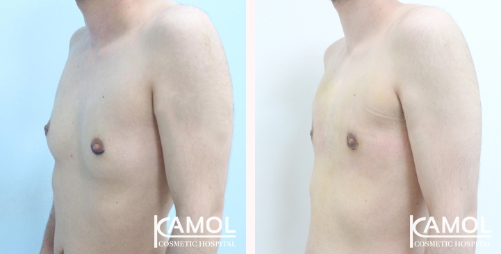 Before and After Mastectomy (Top Surgery)  U-Shape Scar technique