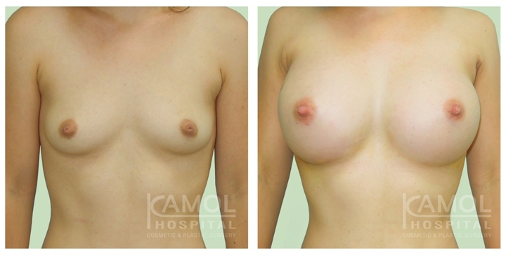 Male to Female Breast Surgery