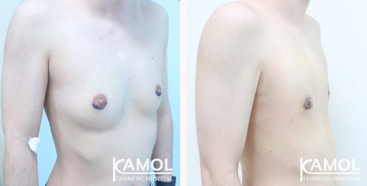 Before and After Mastectomy (Top Surgery)  U-Shape Scar technique