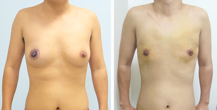 Before and After Mastectomy (Top Surgery) O-Shape Scar technique