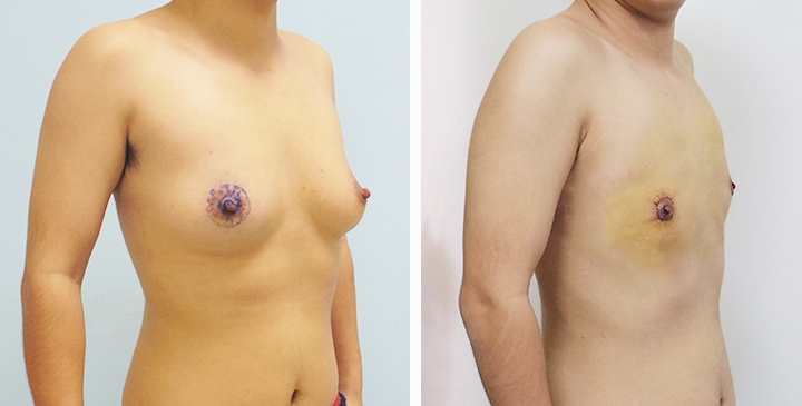 Before and After Mastectomy (Top Surgery) O-Shape Scar technique