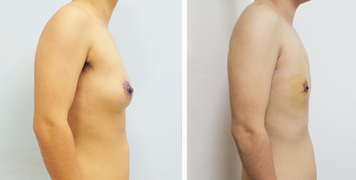 Before and After Mastectomy (Top Surgery) O-Shape Scar technique