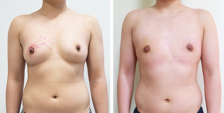 Before and After Mastectomy (Top Surgery) O-Shape Scar technique