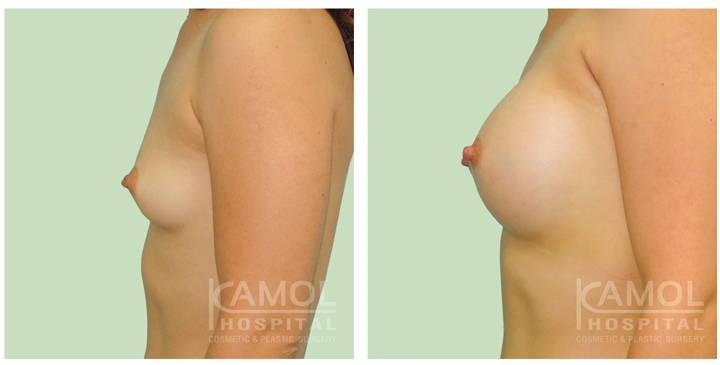 Male to Female Breast Surgery