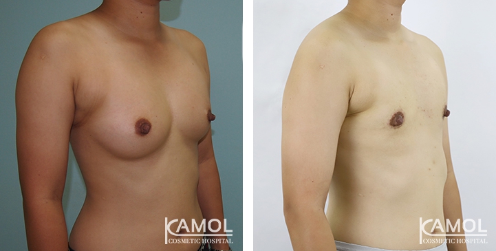 Before and After Mastectomy (Top Surgery) O-Shape Scar technique