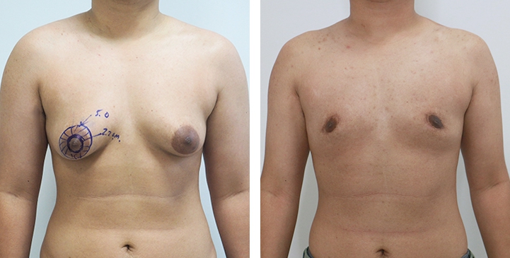 Before and After Mastectomy (Top Surgery) O-Shape Scar technique