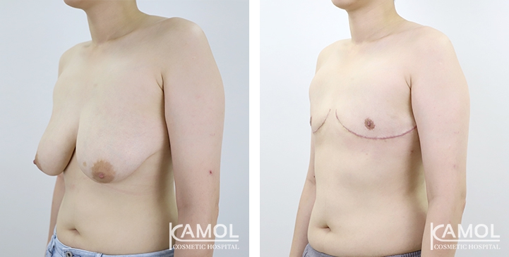 Before and After Mastectomy (Top Surgery) 