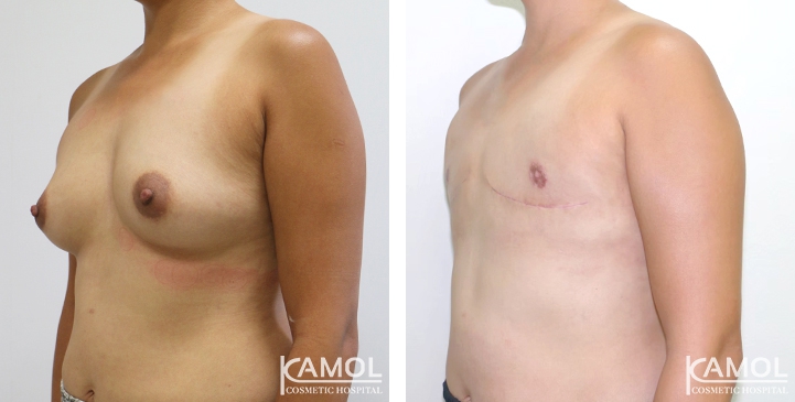 Before and After Mastectomy (Top Surgery) 