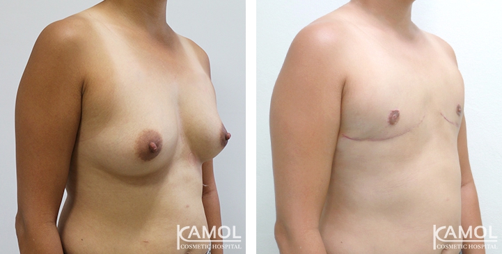 Before and After Mastectomy (Top Surgery) 