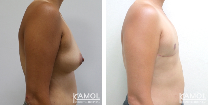 Before and After Mastectomy (Top Surgery) 