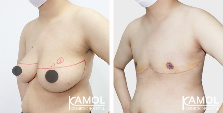 Before and After Mastectomy (Top Surgery) 