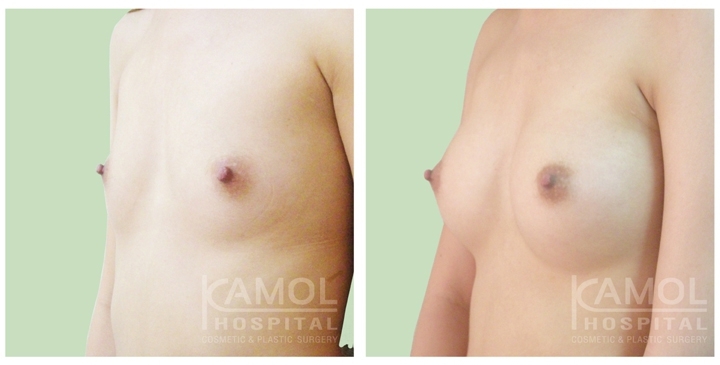 Male to Female Breast Surgery