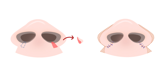 Shows the incision scar to excising the middle of the nostrils base