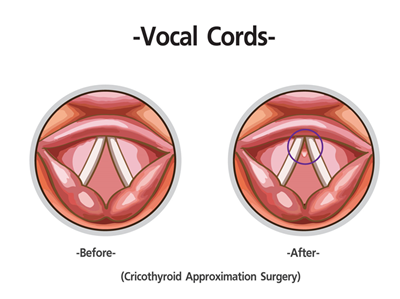 ก่อนและหลังการผ่าตัดเส้นเสียง