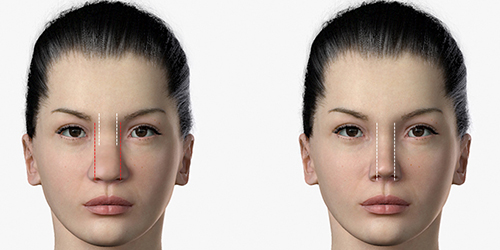 Shows before and after rhinoplasty by lateral Osteotomy