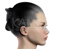 After Augmentation Rhinoplasty