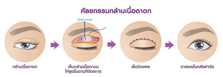 แสดงขั้นตอนการทำศัลยกรรมตาตก กล้ามเนื้อตาตก