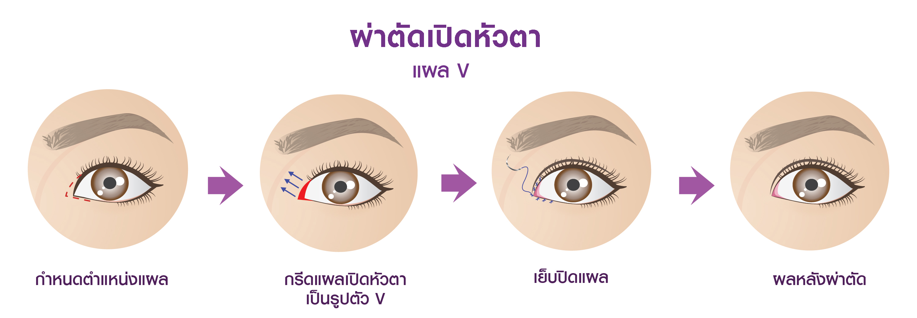 แสดงขั้นตอนการทำ ศัลยกรรมเปิดหัวตา แผล V