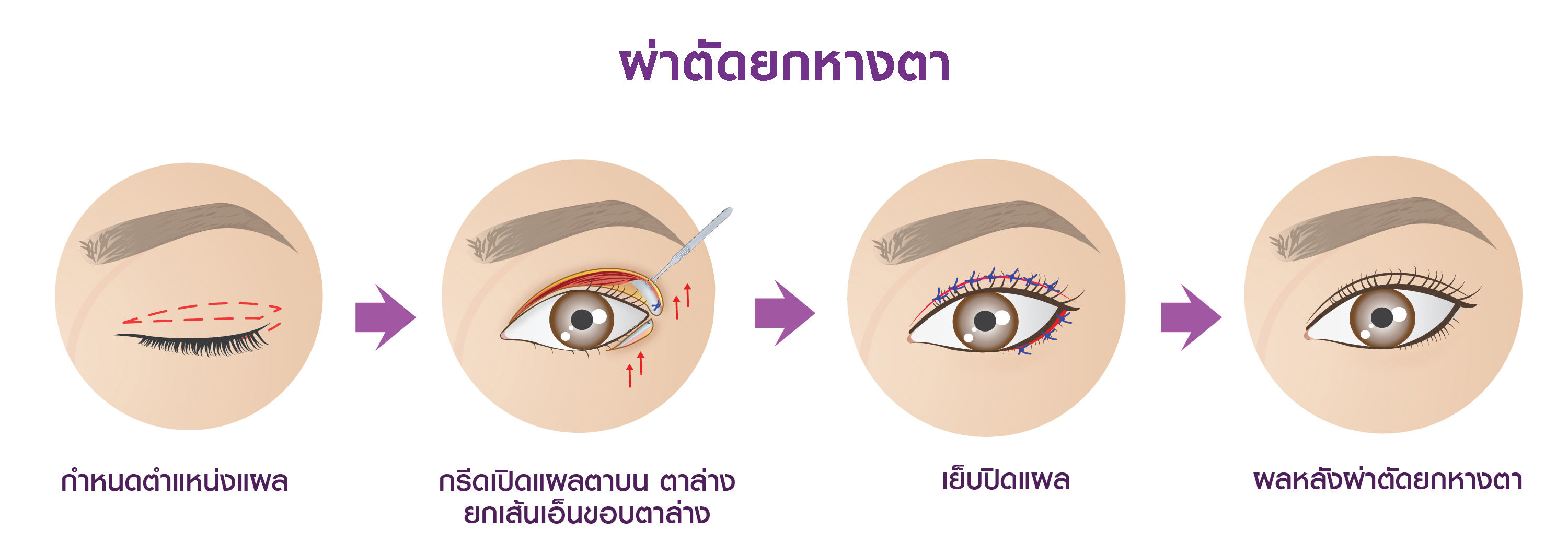 แสดงขั้นตอนการทำ ศัลยกรรมยกหางตา