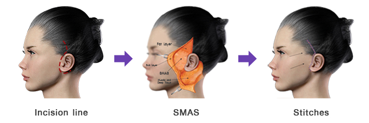 การผ่าตัดดึงหน้าโดยวธีผ่าตัดแยกเอาชั้นของ SMAS