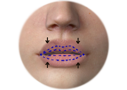 Shows the incision line and the result of lip reduction.