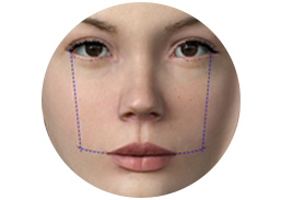 Shows the incision and result of a dimples surgery