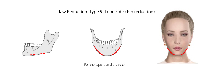 Shows jaw reduction type 5: long side chin reduction.