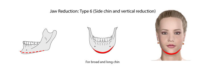 Shows Jaw reduction type 6: side chin and vertical reduction. 