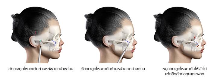 shows Zygomatic Bone, Zygomatic arch