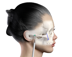 Positioning of Zygoma Reduction (Cheekbone Reduction)